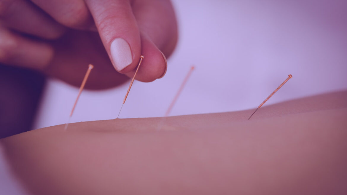 Acupuncture
